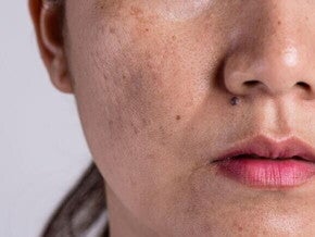 close-up de rosto feminino com manchas de cloasma visíveis na pele.