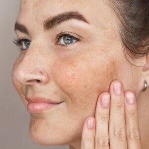 mulher de olhos claros com manchas escuras no rosto, tocando a bochecha suavemente.