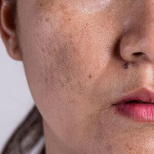 close-up de rosto feminino com manchas de cloasma visíveis na pele. close-up de rosto feminino com manchas de cloasma visíveis na pele.