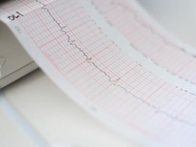 Cardiograma sendo impresso durante exame Cardiograma sendo impresso durante exame