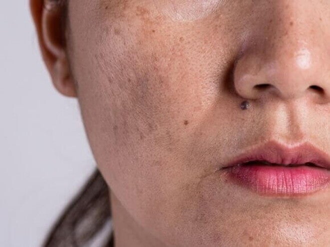 close-up de rosto feminino com manchas de cloasma visíveis na pele. close-up de rosto feminino com manchas de cloasma visíveis na pele.