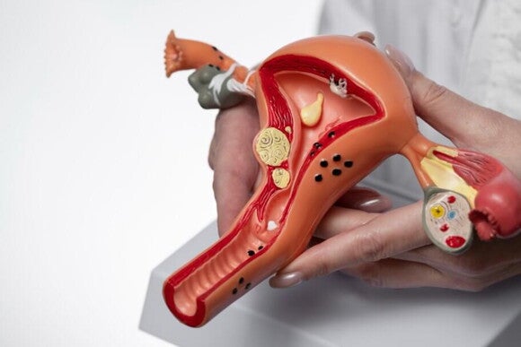 Imagem de um órgão reprodutor feminino para explicar a endometriose Imagem de um órgão reprodutor feminino para explicar a endometriose