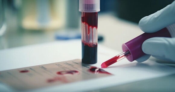 Um técnico examina um frasco de sangue sob um microscópio Um técnico examina um frasco de sangue sob um microscópio